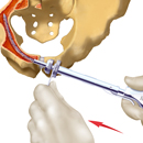 Capillary Constriction